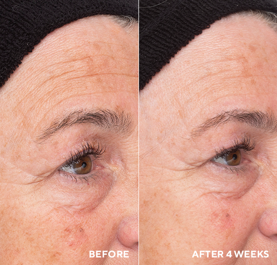 Liquid Resurfacing Solution