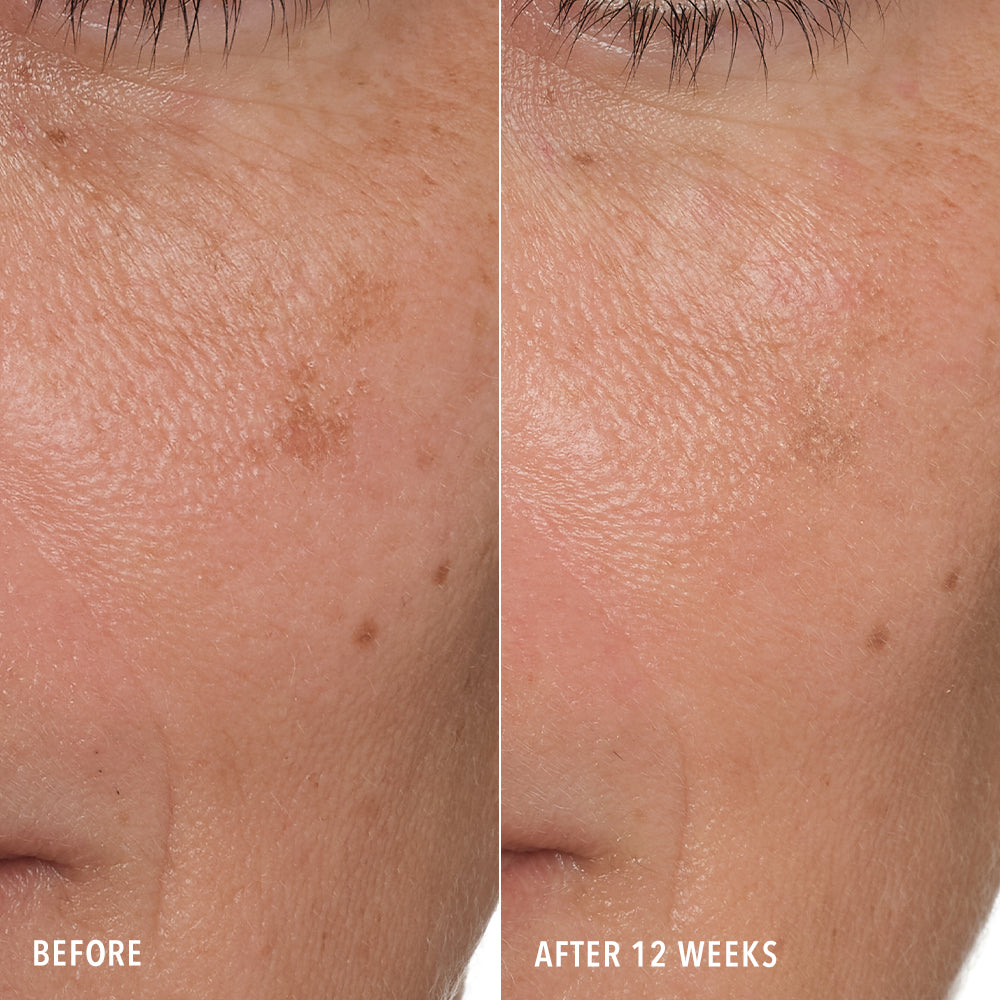 Close-up before-and-after comparison of facial skin texture and sun damage on the cheek, labeled 'BEFORE' and 'AFTER 12 WEEKS'.