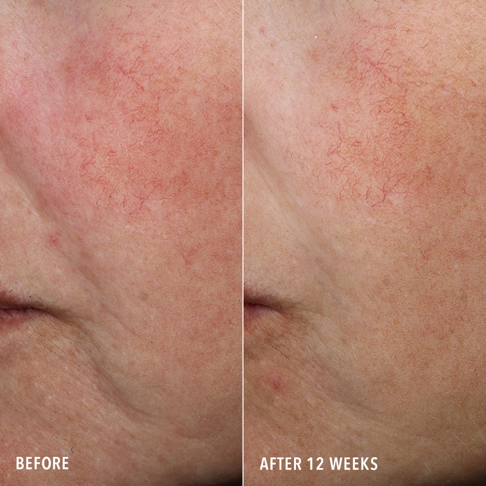 Close-up before-and-after comparison of facial skin showing visible red veins under the eyes, labeled 'BEFORE' on the left and 'AFTER 12 WEEKS' on the right.
